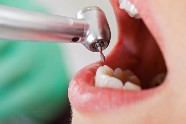 Best Emergency Treatment for Dental Infections or Abscesses in Sheridan, CO